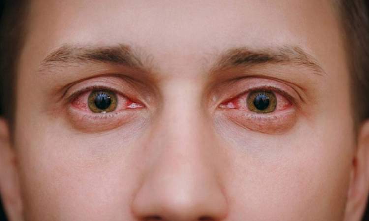 علامات في العين تحدد مشاكلك الصحية