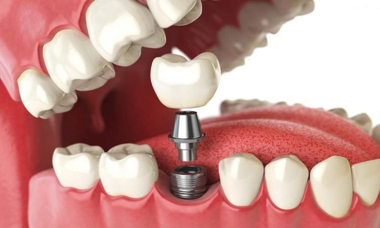 الدكتورة الحماني: تلبيس الاسنان تمر بعدة مراحل