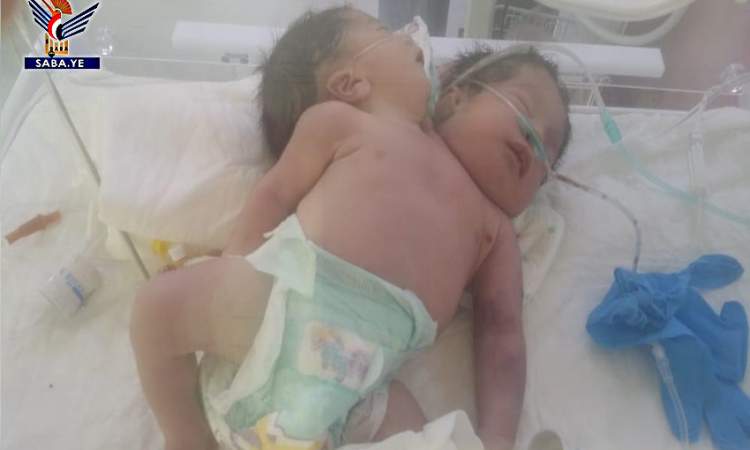 ولادة توأم سيامي بحالة حرجة في مستشفى فلسطين
