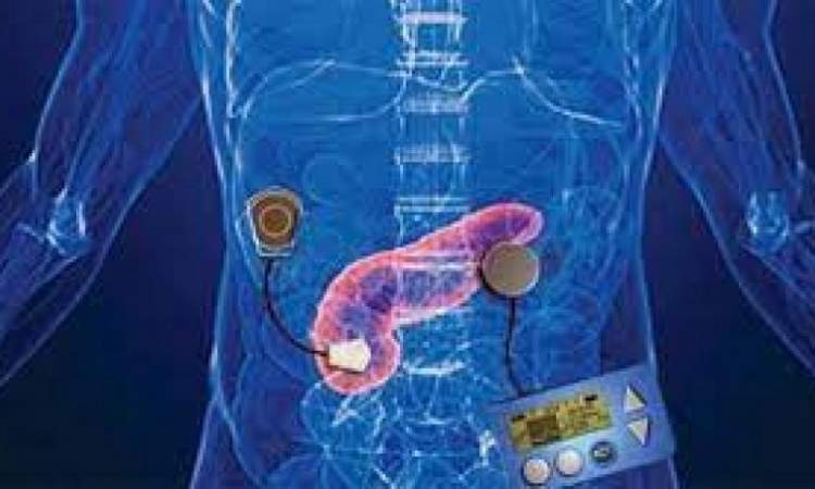 علماء يطوّرون 'بنكرياس إصطناعي' للسيطرة على مرض السكري