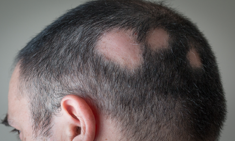 دواء جديد يعيد 80٪ من الشعر لمرضى الثعلبة