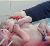 ولادة توأم سيامي في مستشفى السبعين - صور