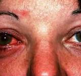 تفشي مرض العين الوردية في عدد من دول اسيا وافريقيا ورواندا تصدر تحذيرا 