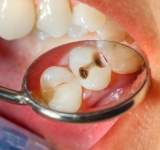 طبيبة اسنان تحذر من عواقب عدم معالجة تسوس الاسنان