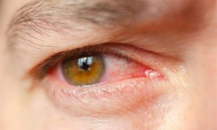 علامات في الوجه والعين تنذر بارتفاع مستوى الكوليسترول