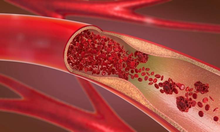 هل يمكن علاج تصلب الشرايين؟